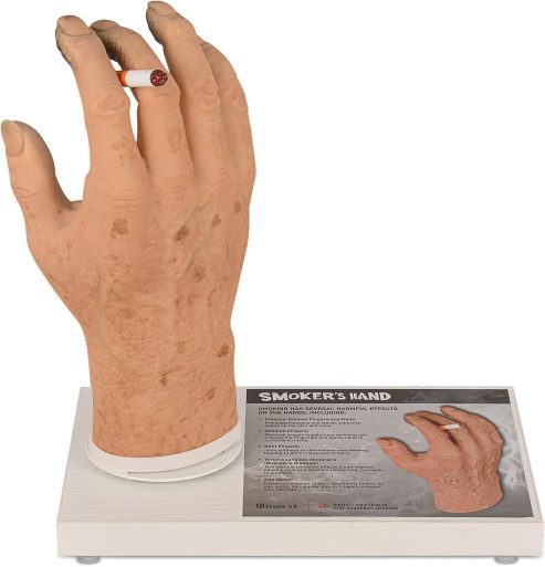 Ultrassist Smoker's Hand Model for Anti-Smoking Education