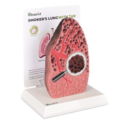 Ultrassist Cross-Sectional Smoking Lung Model – Realistic Tar Damage for Smoking Education