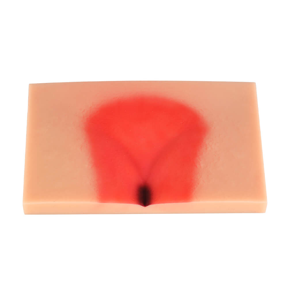 Decubitus Ulcer/Bedsore Model Set, Stage I–IV