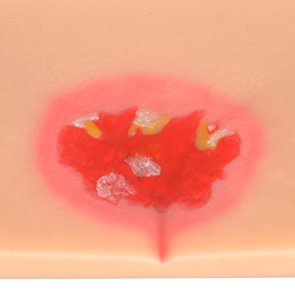 Decubitus Ulcer/Bedsore Model Set, Stage I–IV