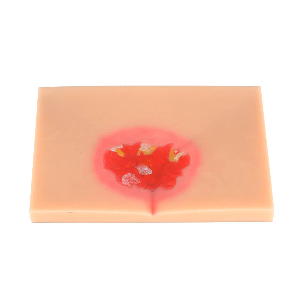 Decubitus Ulcer/Bedsore Model Set, Stage I–IV