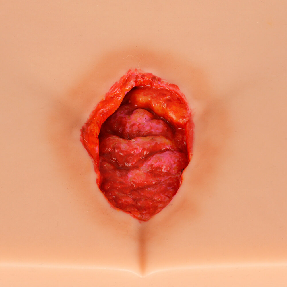 Decubitus Ulcer/Bedsore Model Set, Stage I–IV