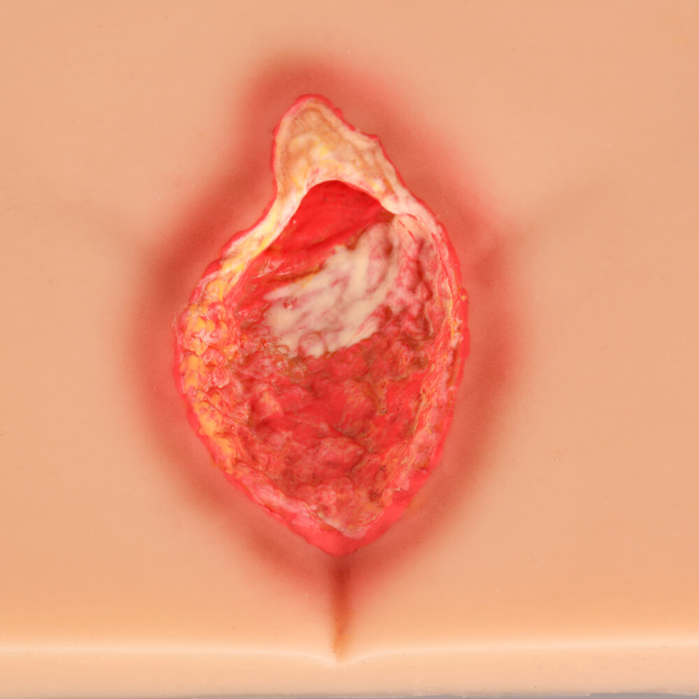 Decubitus Ulcer/Bedsore Model Set, Stage I–IV