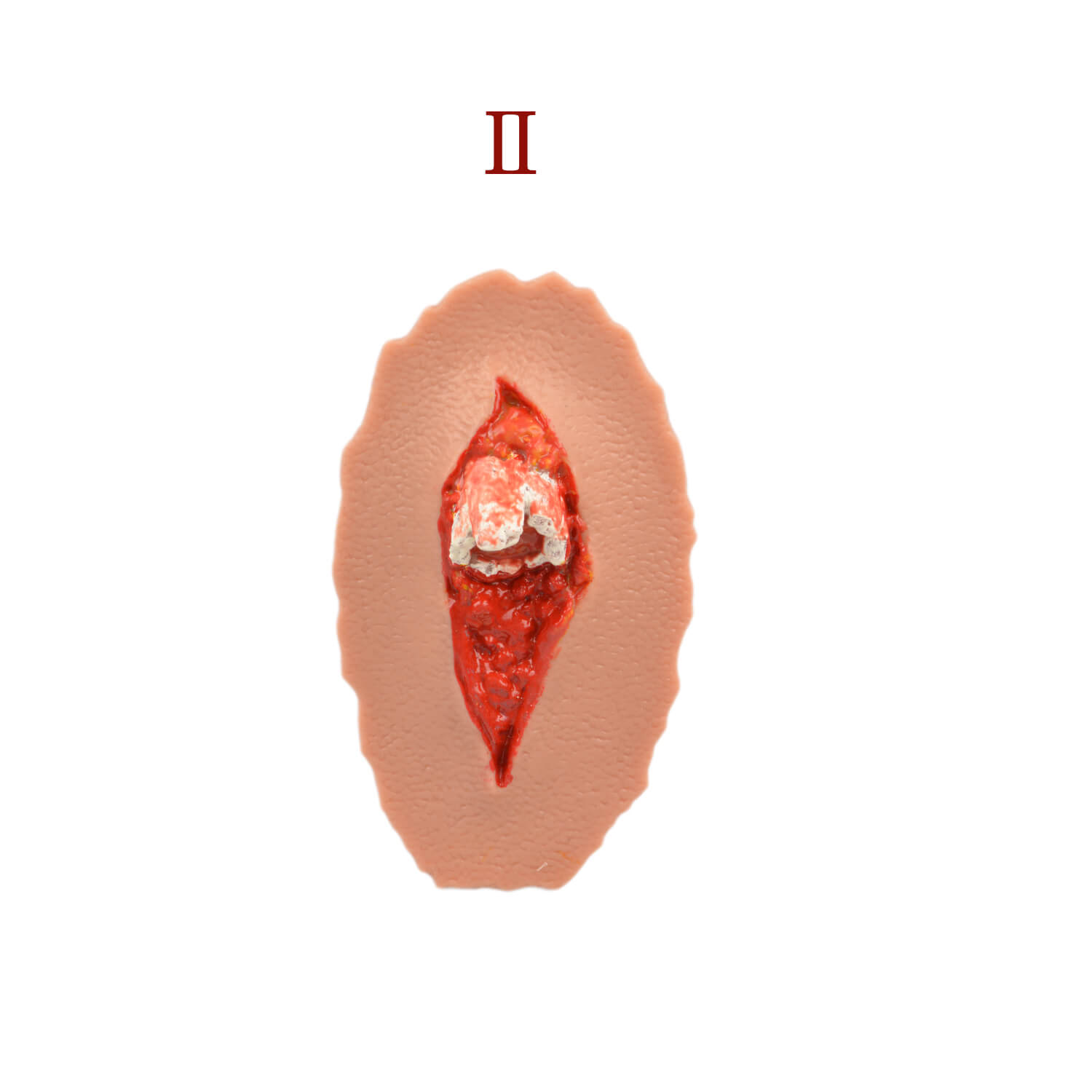 Grade 2 Open Fracture Wound Moulage Kit