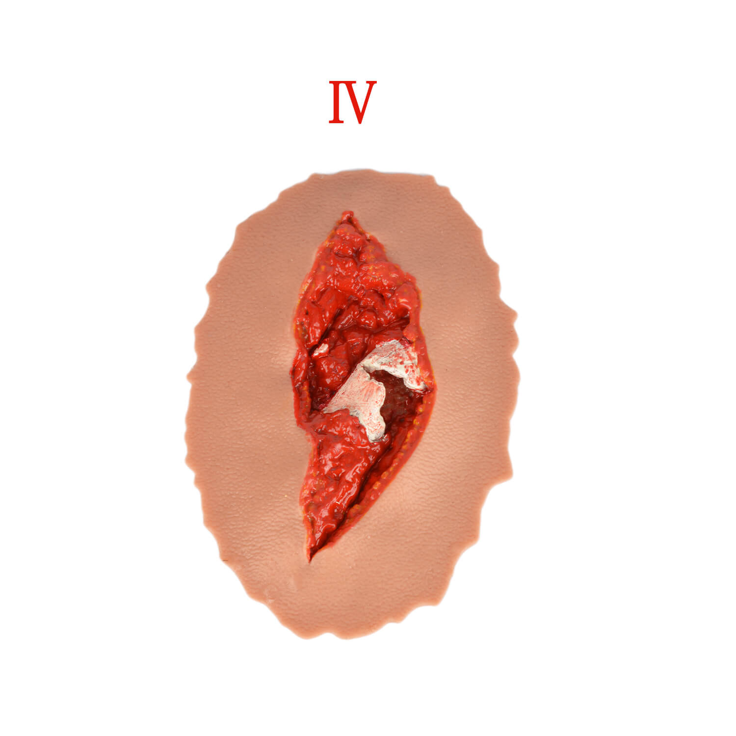Grade 4 Open Fracture Wound Moulage Kit