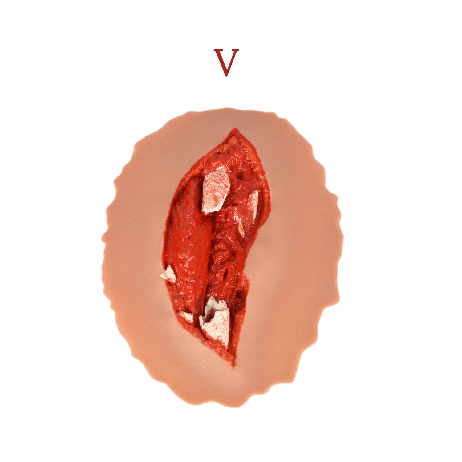 Grade 5 Open Fracture Wound Moulage Kit