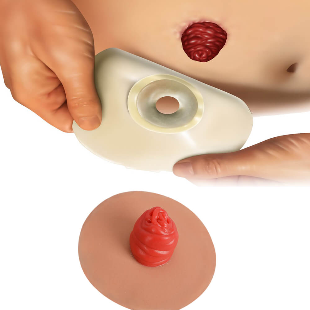 Sticky Ostomy Simulators Set for Stoma Care Practice
