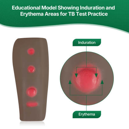 Palpable TB Testing Arm Set (Mantoux Method)