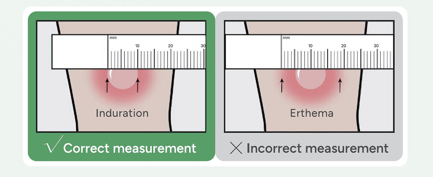 Palpable TB Testing Arm Set