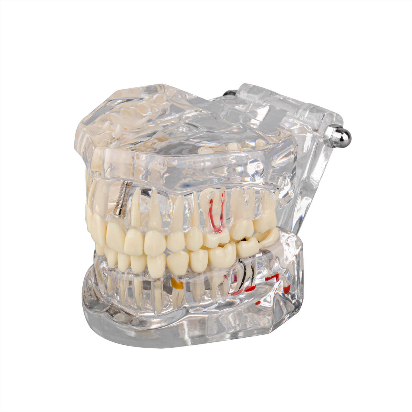 Transparent Disease Teeth Model with Dental Implant Bridge