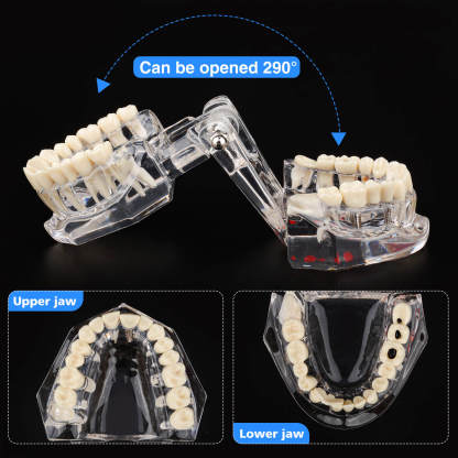 Transparent Disease Teeth Model with Dental Implant Bridge