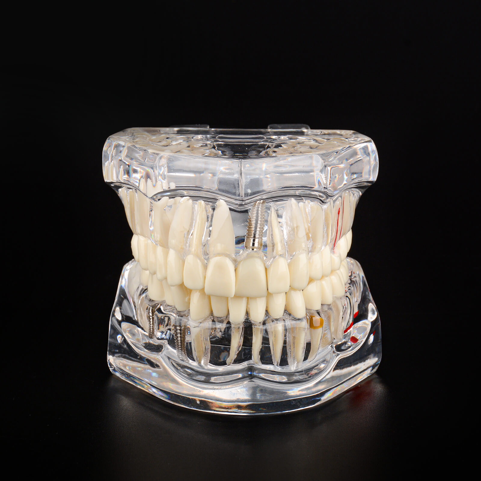 Transparent Disease Teeth Model with Dental Implant Bridge
