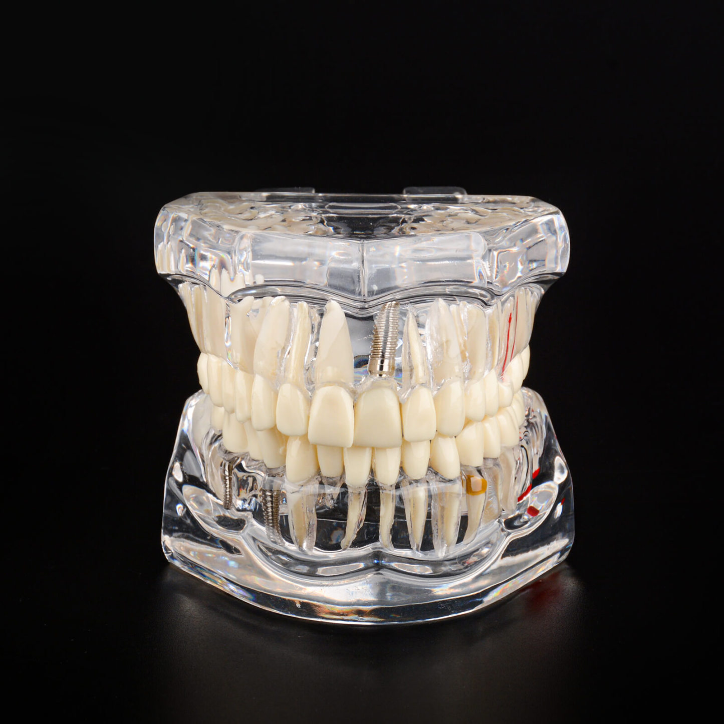 Transparent Disease Teeth Model with Dental Implant Bridge