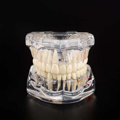 Transparent Disease Teeth Model with Dental Implant Bridge