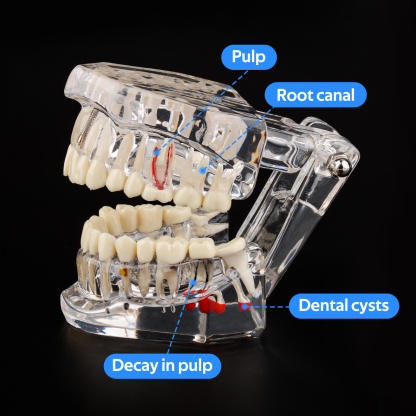 Transparent Disease Teeth Model with Dental Implant Bridge