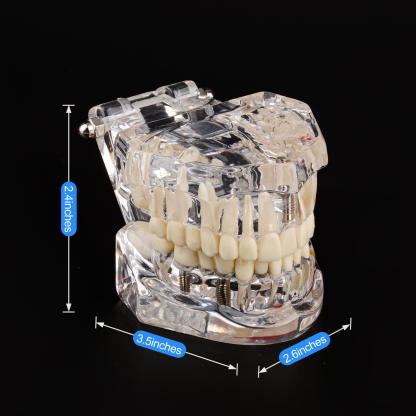 Transparent Disease Teeth Model with Dental Implant Bridge