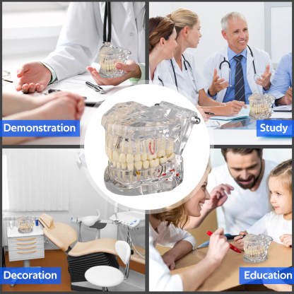 Transparent Disease Teeth Model with Dental Implant Bridge