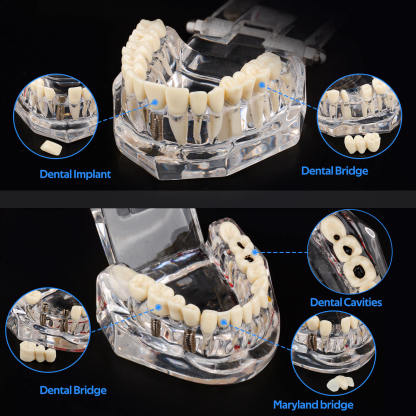 Transparent Disease Teeth Model with Dental Implant Bridge