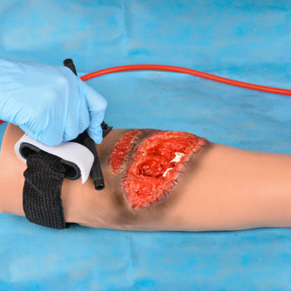 Trauma Arm with Laceration and Fracture Wound 