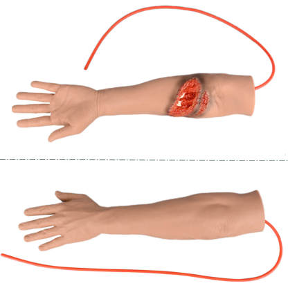 Trauma Arm with Laceration and Fracture Wound 