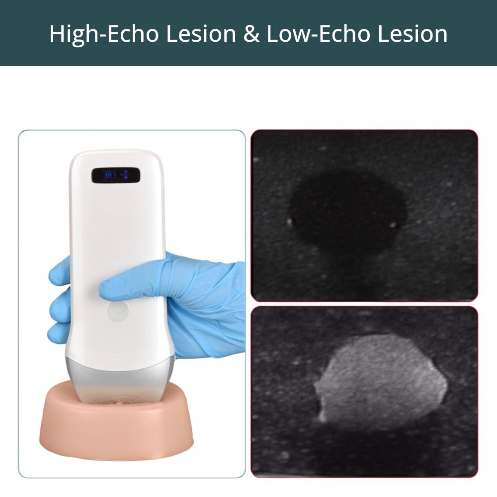 Skin-Tone Ultrasound Biopsy Phantom with Dual-Echoic Lesions