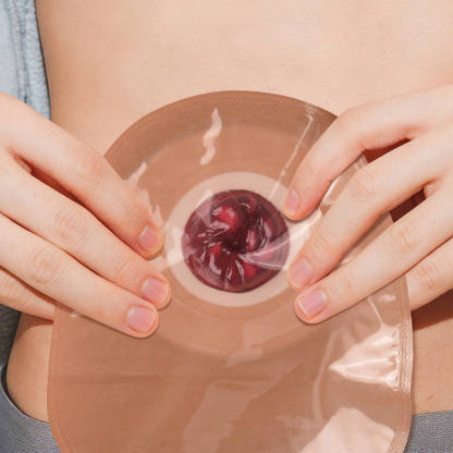 Unhealthy Stoma Simulation Models Set for Ostomy Care Training