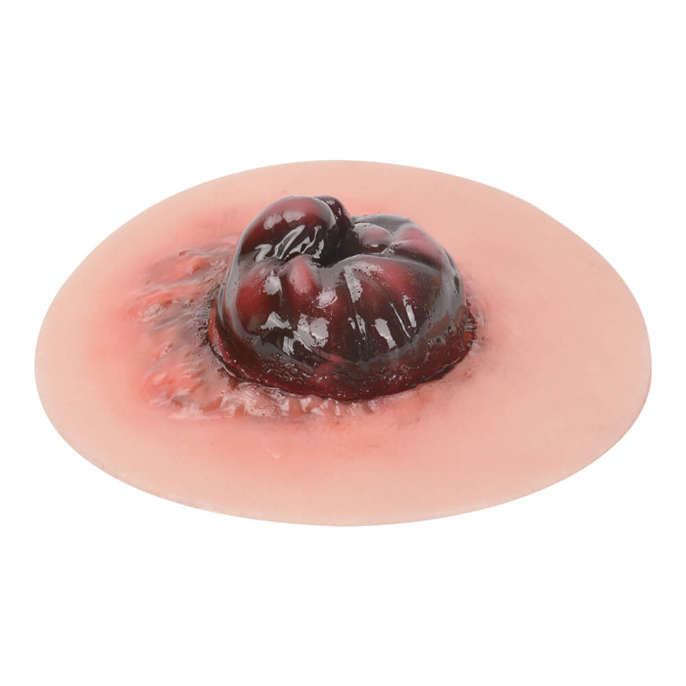 Sticky Unhealthy Stoma Simulation Model