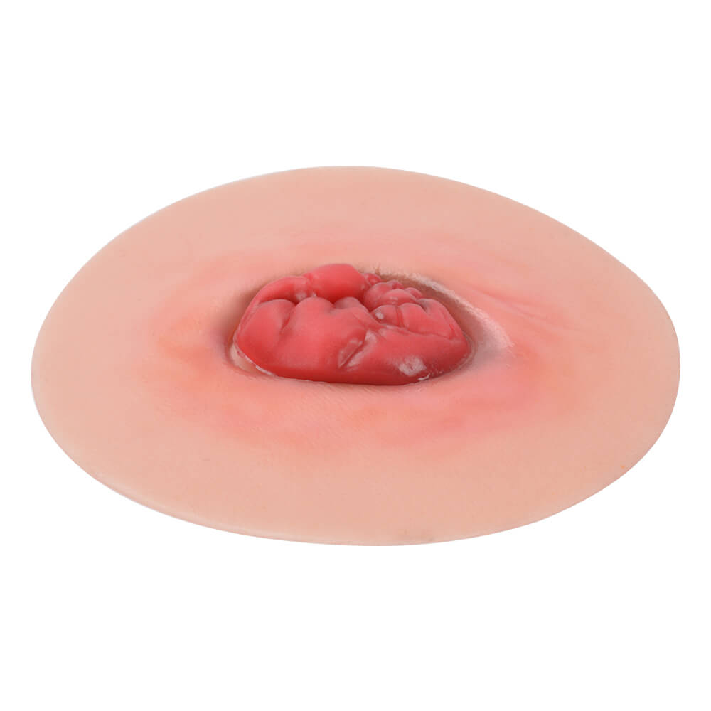 Unhealthy Stoma Conditions Model