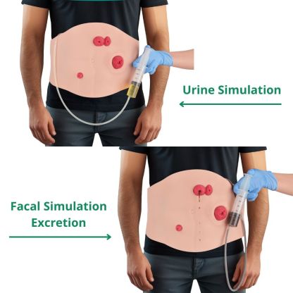 Ultrassist Wearable Belly Ostomy Training Model with Simulated Excretion