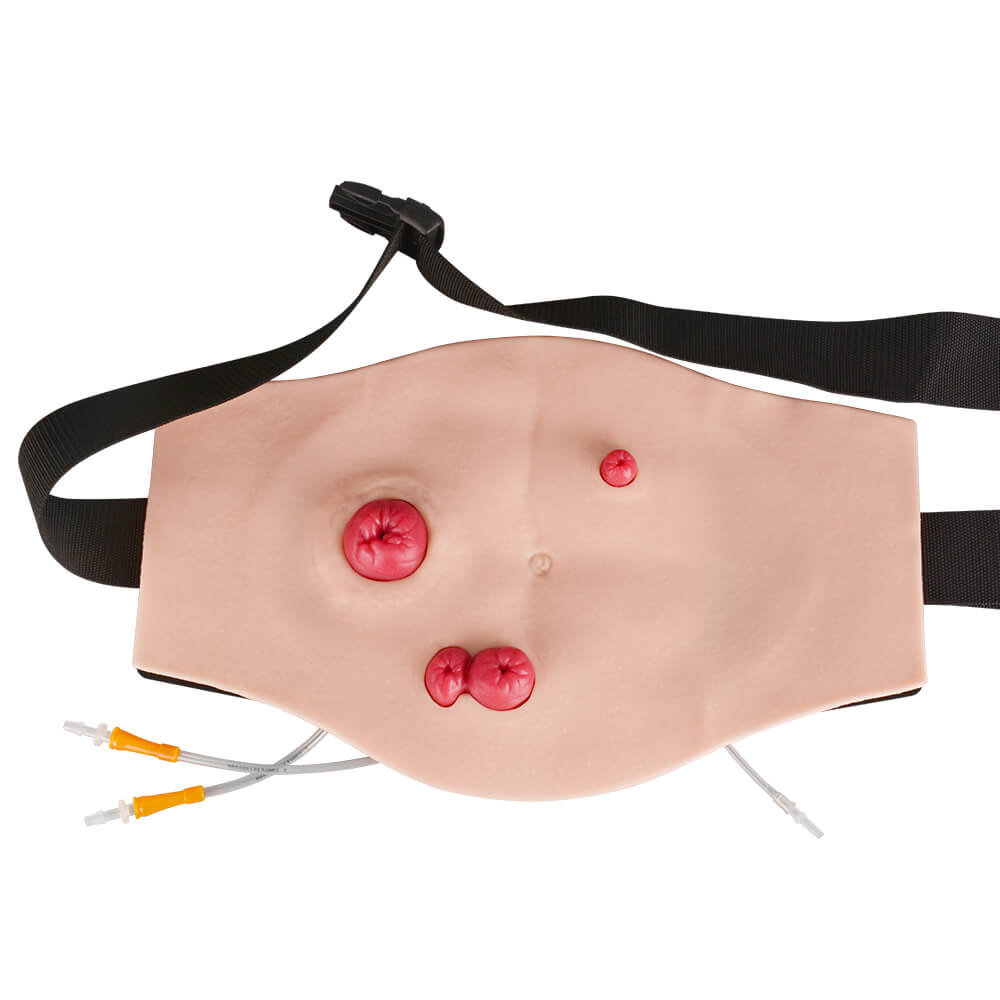 Ultrassist Wearable Belly Ostomy Training Model with Simulated Excretion