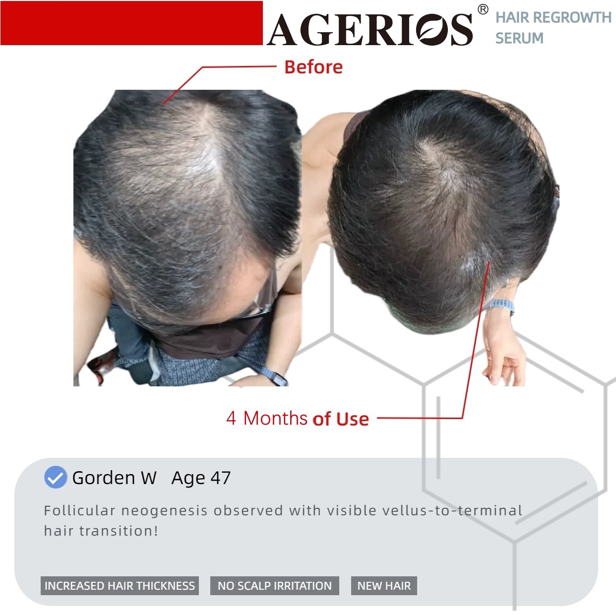 AGerios Hair Regrowth Serum