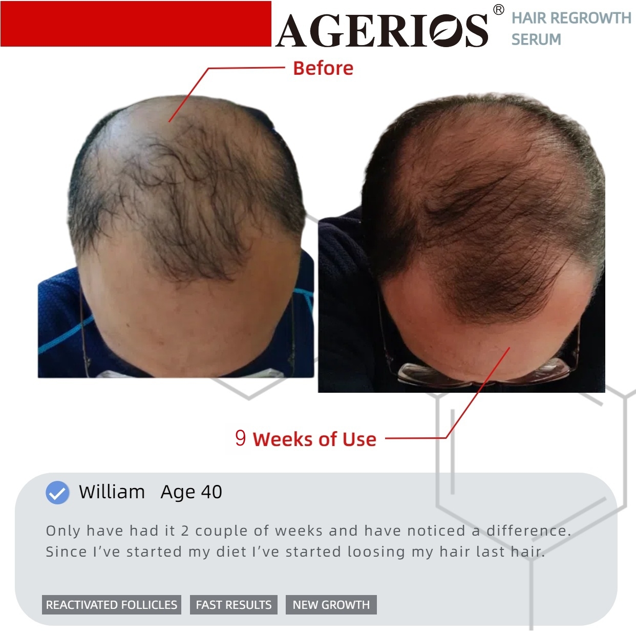 AGerios Hair Regrowth Serum