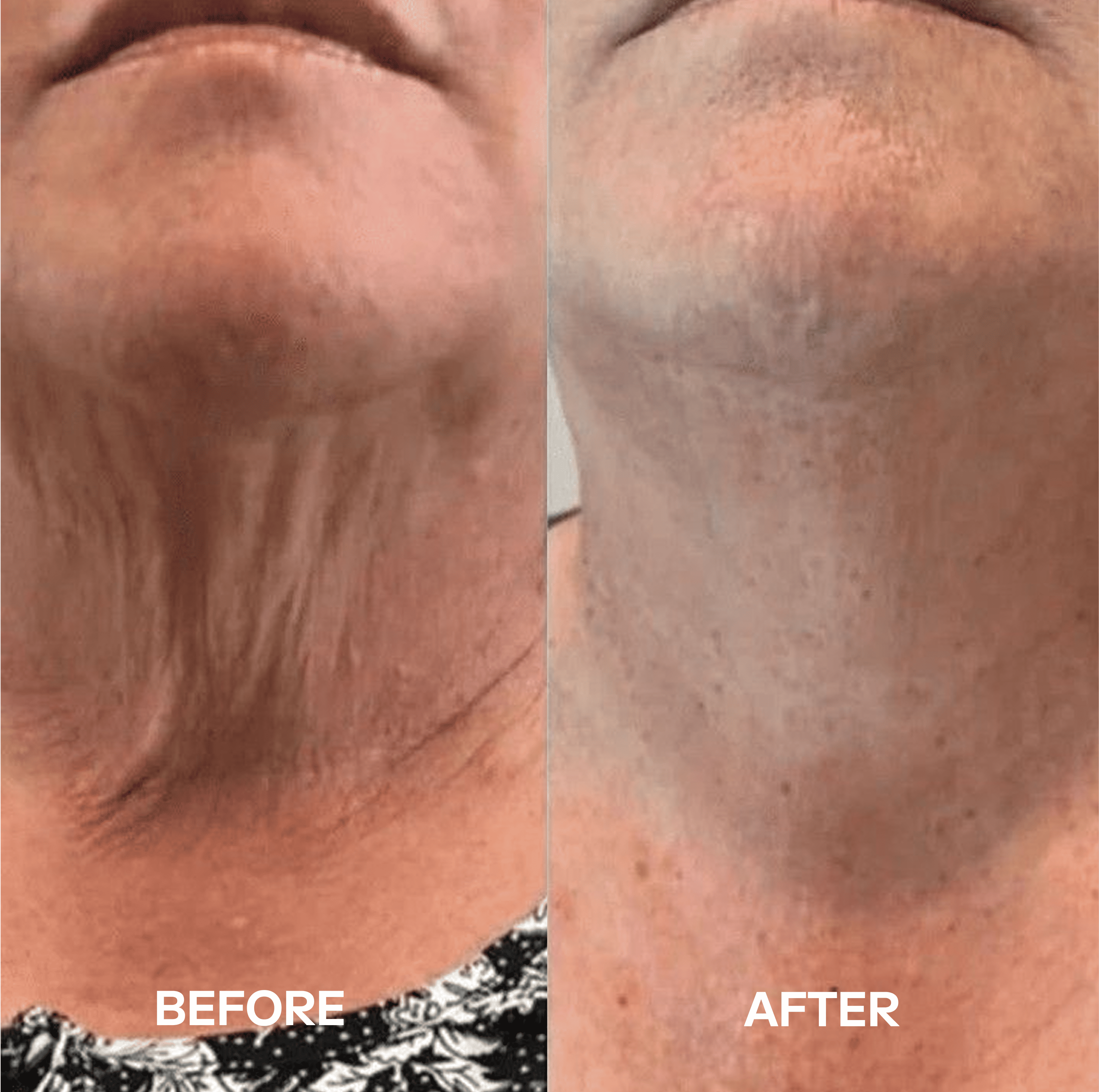 Healatia™ Neck Masks