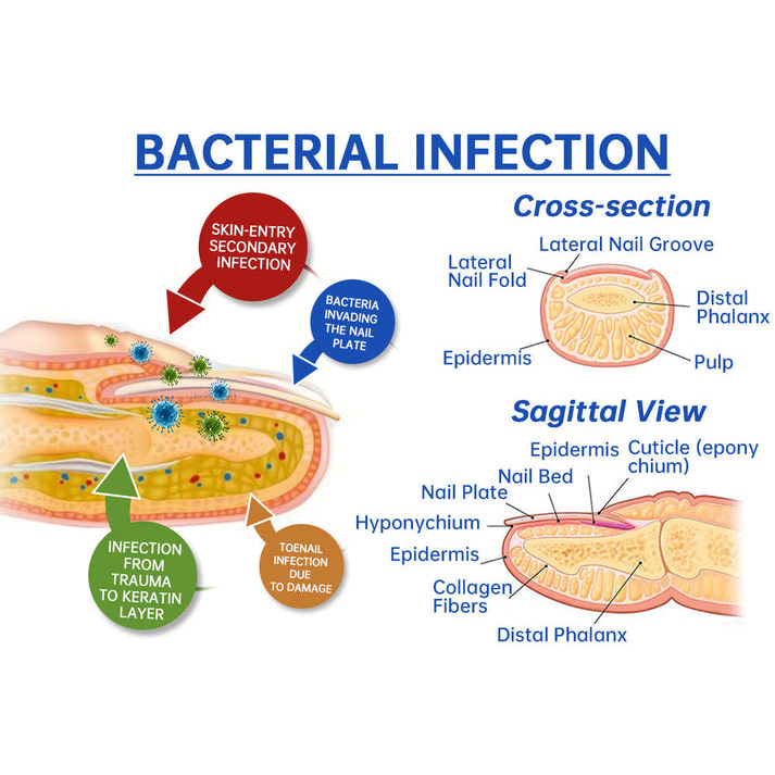 ✨Hot Sale - 49% OFF 💥Welnax™ PureNail Fungus Laser Device