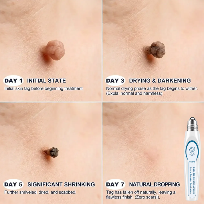 Painless & Scar-Free Advanced Imperfection Removal Rollerball Pen