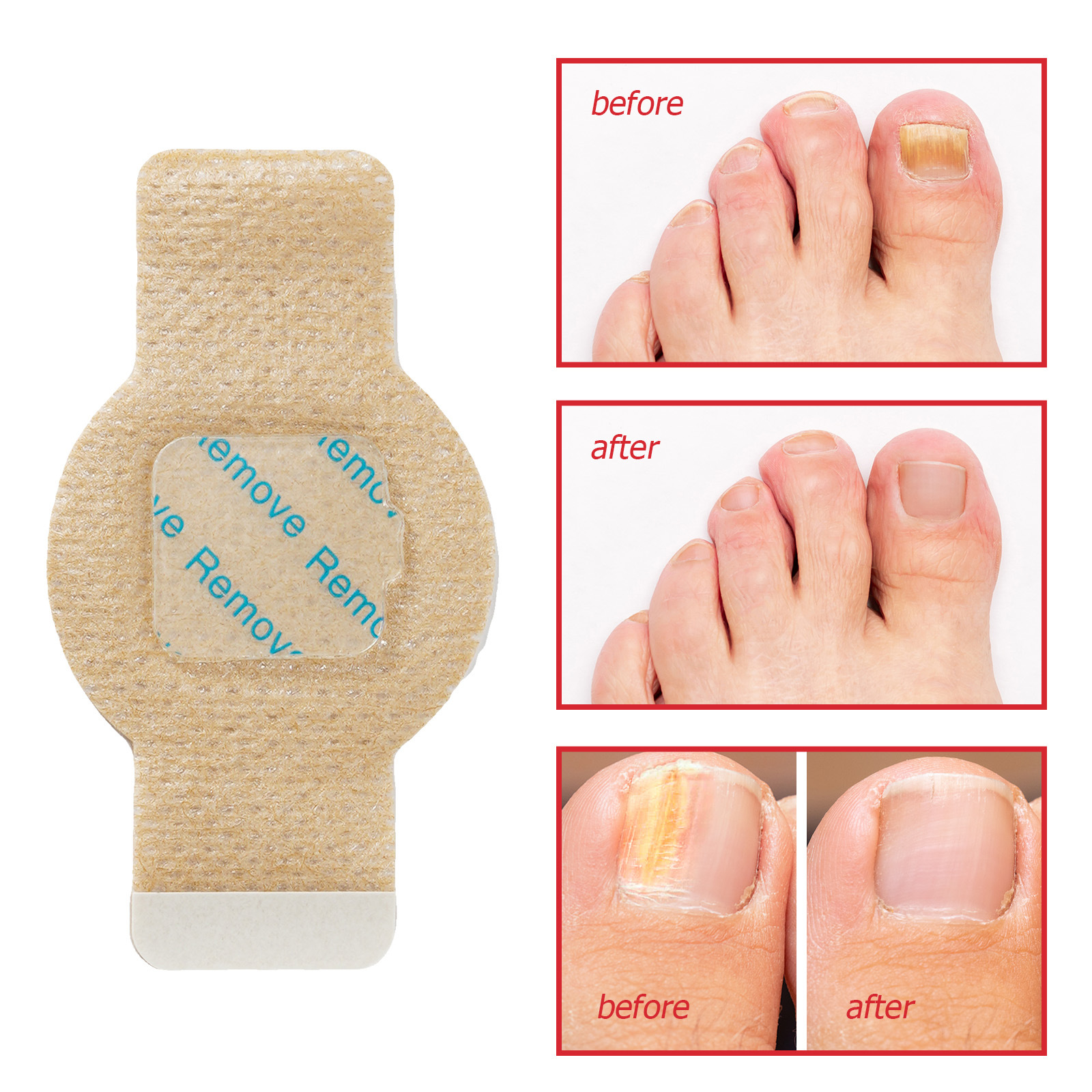 Fungal Nail Renewal Patches