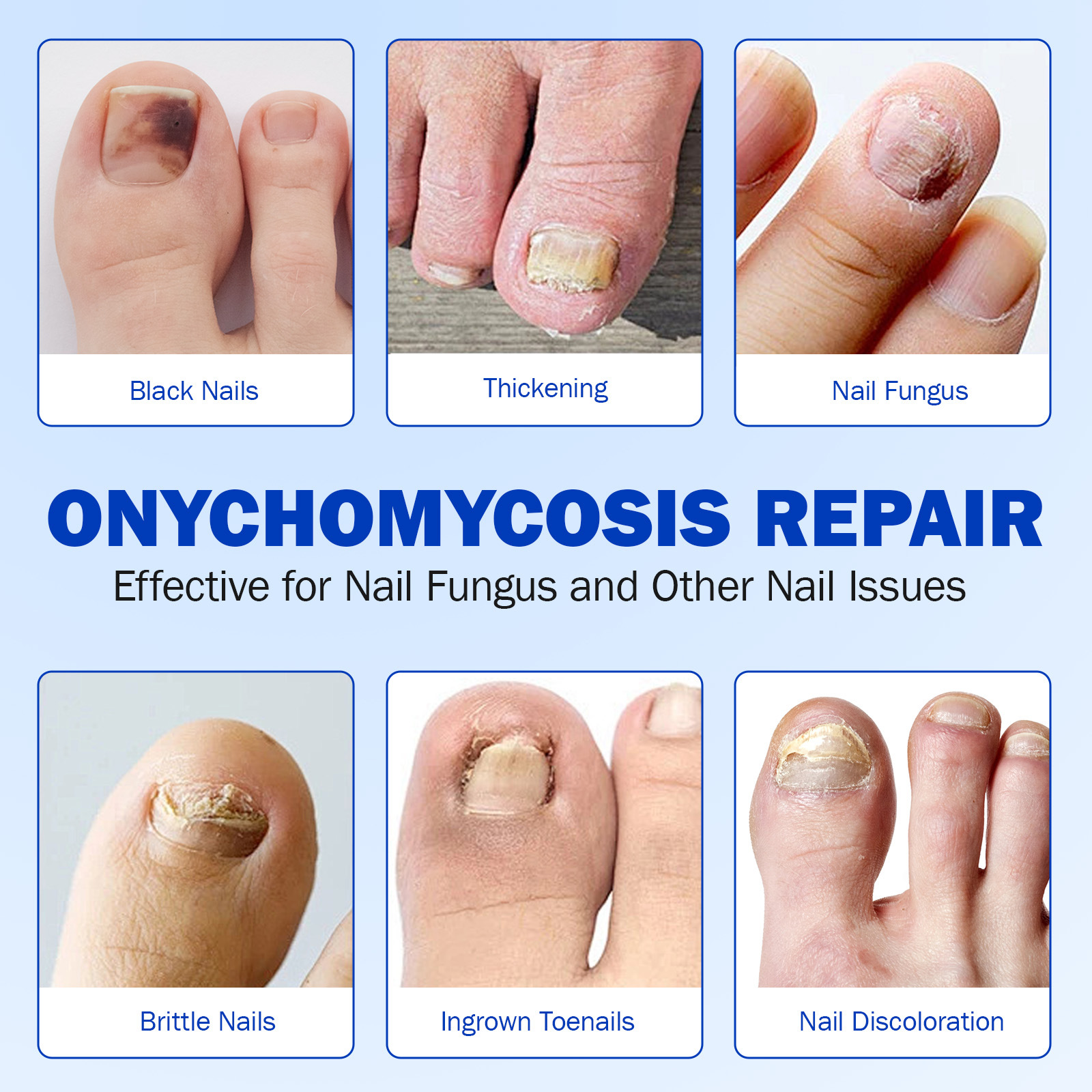 Fungal Nail Renewal Patches