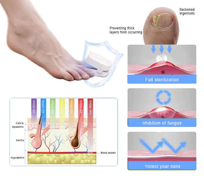 Revolutionary High-Efficiency Light Therapy Device For Toenail Diseases