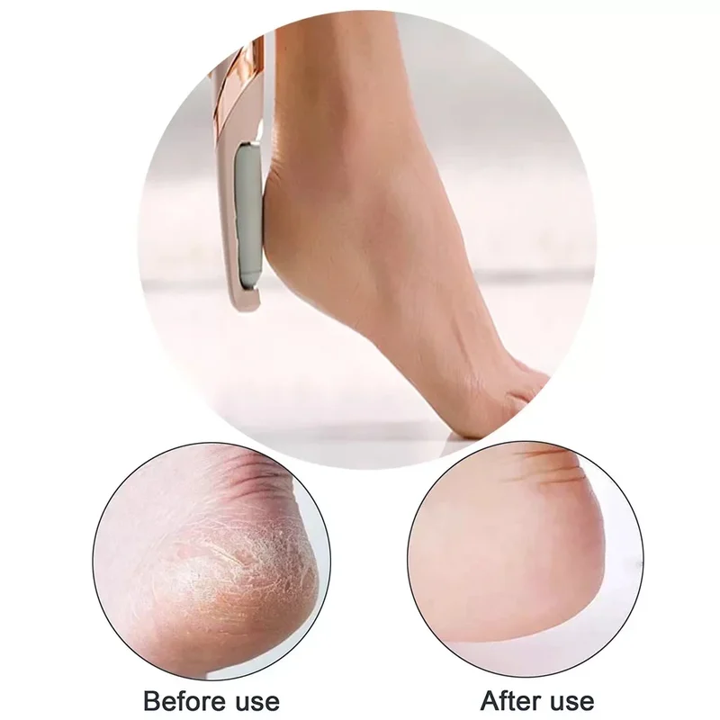 (🔥HOT SALE NOW 49% OFF) - The Foot Callus Remover