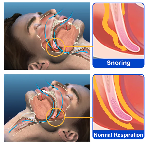Vibrating Pulse Snore Stopper