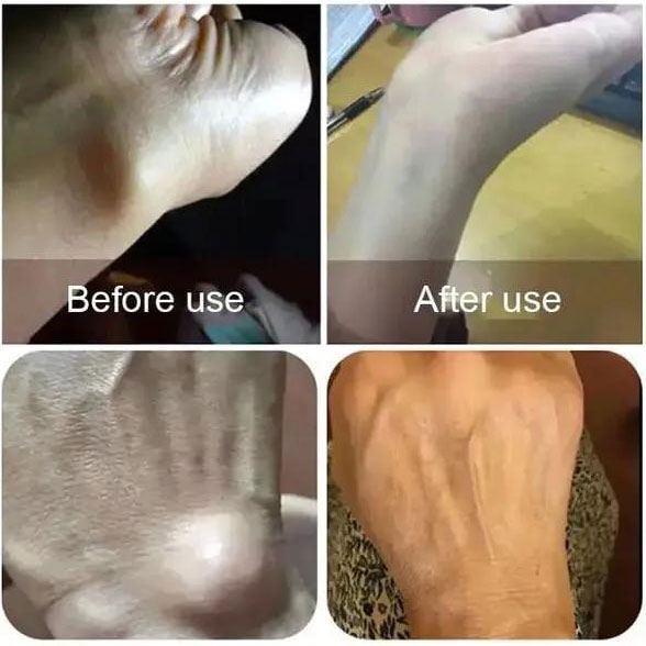 HOT SALE 50% OFF - Hand and foot tenosynovitis spray