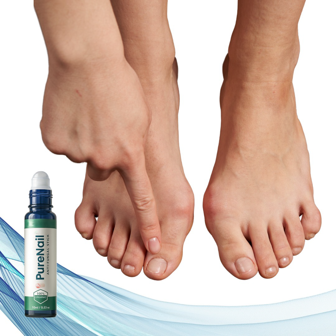 Pure Nail Transforms Thick, Yellow Nails into Healthy Pink Ones Within 48 Hours!