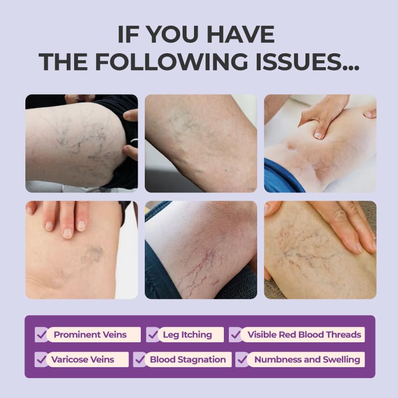 Soothing Leg Cream – Varicose & Spider Veins Relief