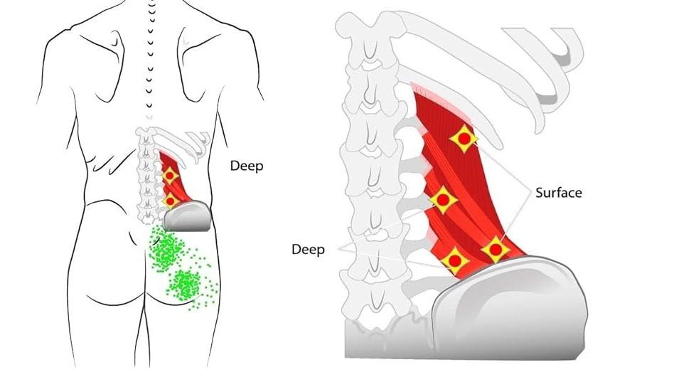 Diagram of deep muscle trigger point locations