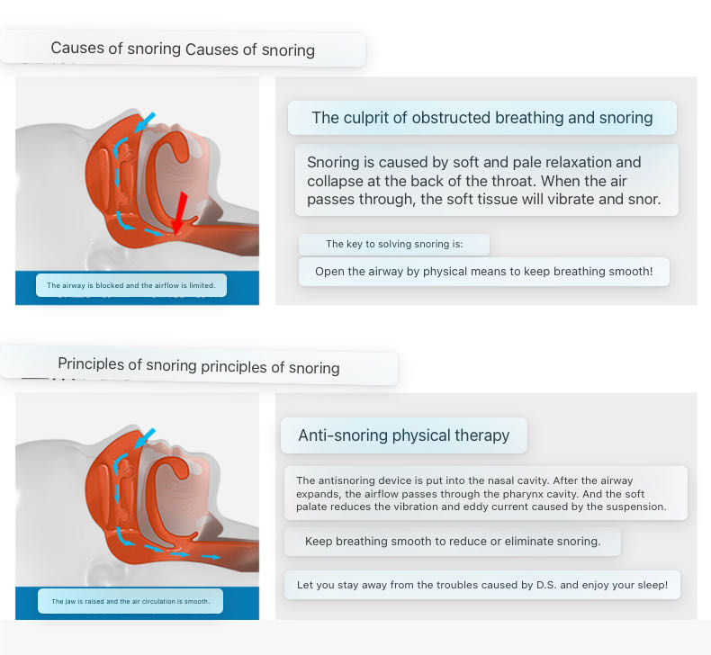 Electric Stop Snoring Device