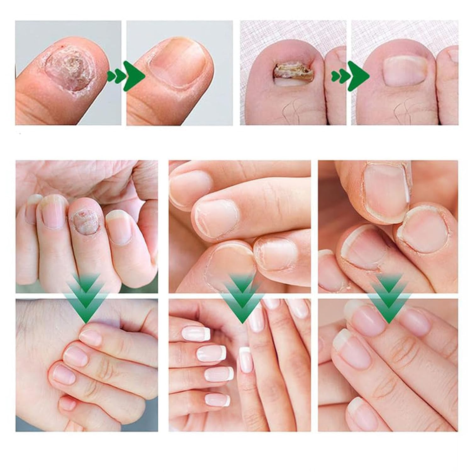 Antifungal Gel - Get rid of nail fungus fast!