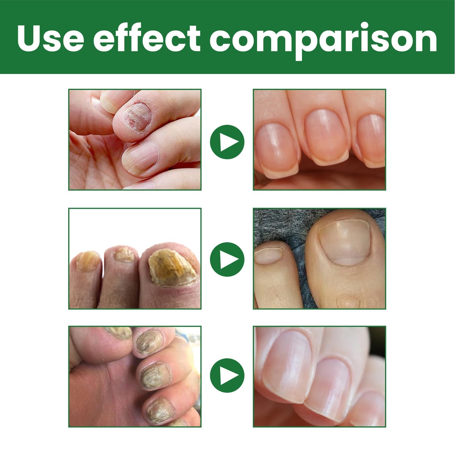 Toenail Fungus Treatment Extra Strength Safely and Gently