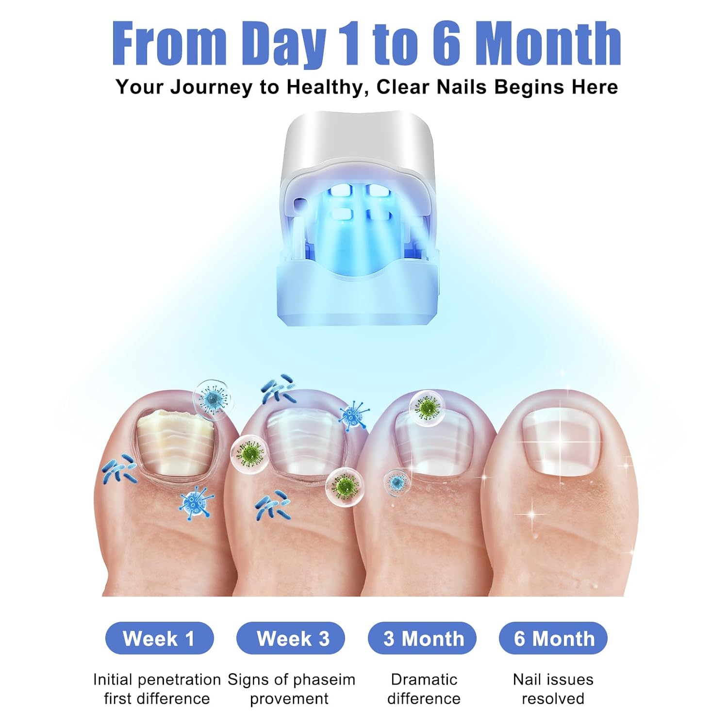 Nail Fungus Treatment Laser for Discolored & Thickened and Paronychia