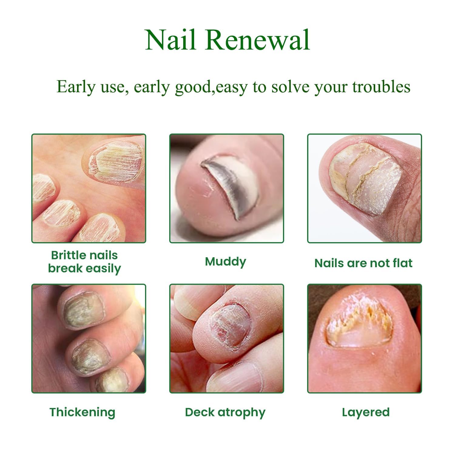 Toenail Fungus Treatment Extra Strength Safely and Gently
