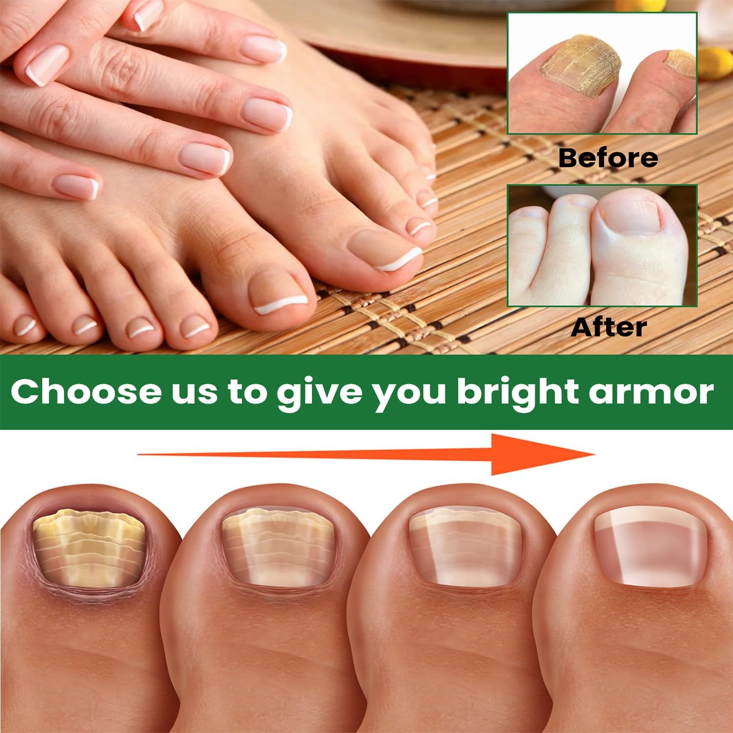 Toenail Fungus Treatment Extra Strength Safely and Gently